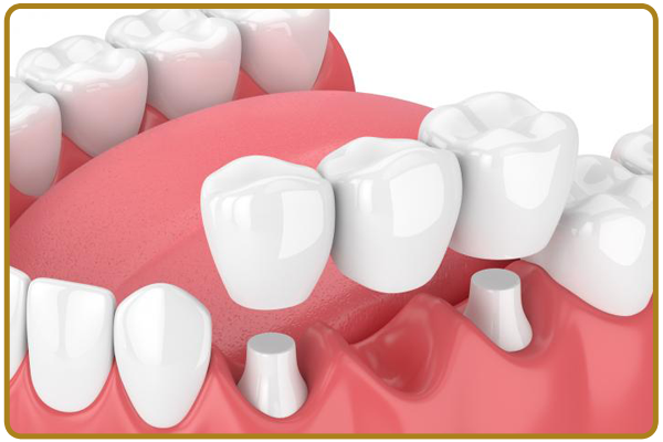 Missing Teeth Replacement